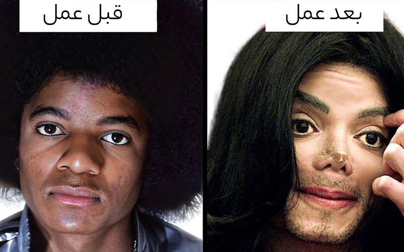 مایکل جکسون قبل و بعد از عمل های جراحی 